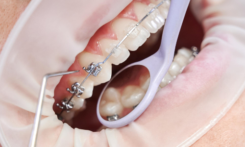 Dental Braces