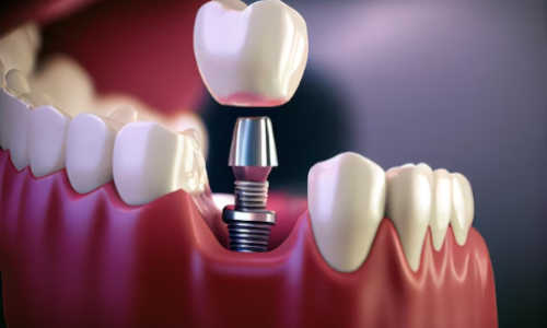 Dental Implants
