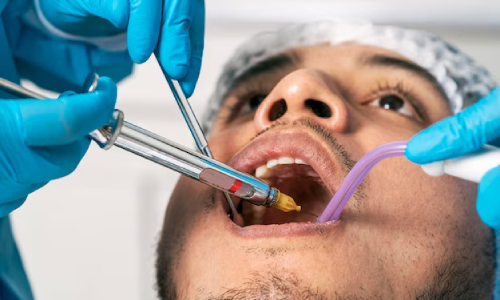 Root Canal Treatment